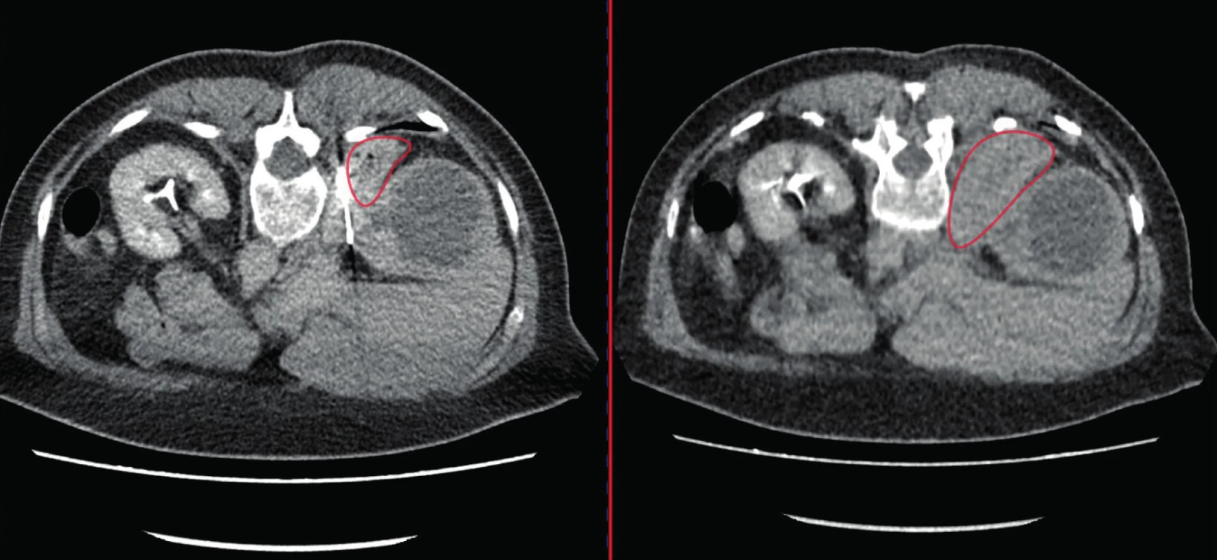 CT, transverzální řez; biopsie pravé ledviny komplikovaná hematomem; vlevo hematom v průběhu
biopsie, vpravo po dokončení biopsie<br>
Fig. 1. CT scan, transverse plane; the biopsy of the right kidney became complicated due to hematoma; in the
left picture – hematoma during the biopsy, in the right picture – hematoma after the biopsy