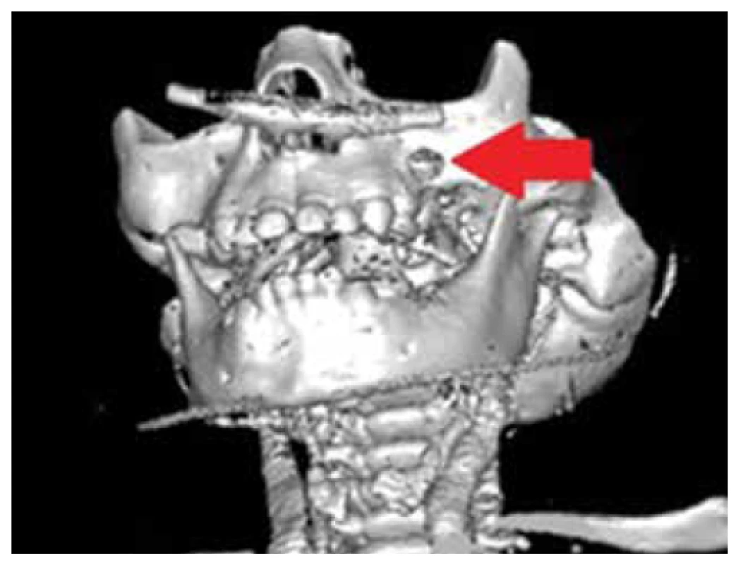 3D rekonštrukcia CT maxily s vyznačeným osteolytickým
defektom nad ľavým alveolárnym výbežkom (zdroj:
archív autorov).<br>
Fig. 4. 3D CT scan of maxilla with marked osteolytic defect
above the left alveolar ridge (source: authors’ archive).