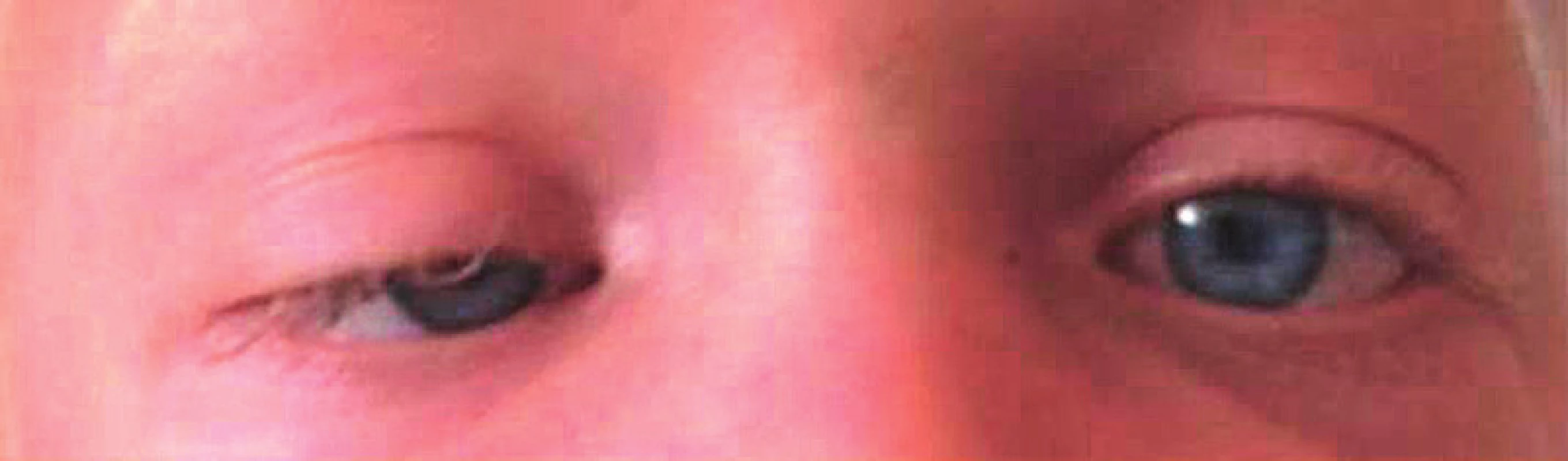 Jednostranná ptóza u dívky s RASopatií na podkladě
patogenní varianty genu SHOC2.<br>
Fig. 3. Unilateral ptosis in a girl with RASopathy due to
a pathogenic SHOC2 gene variant.