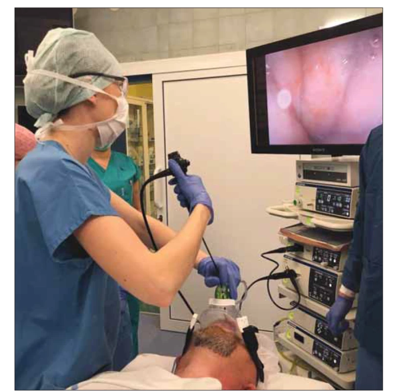 Spánková endoskopie s přetlakovou ventilací, zevní pohled.<br>
Fig. 1. Drug-induced sleep endoscopy with positive airway pressure; external view.