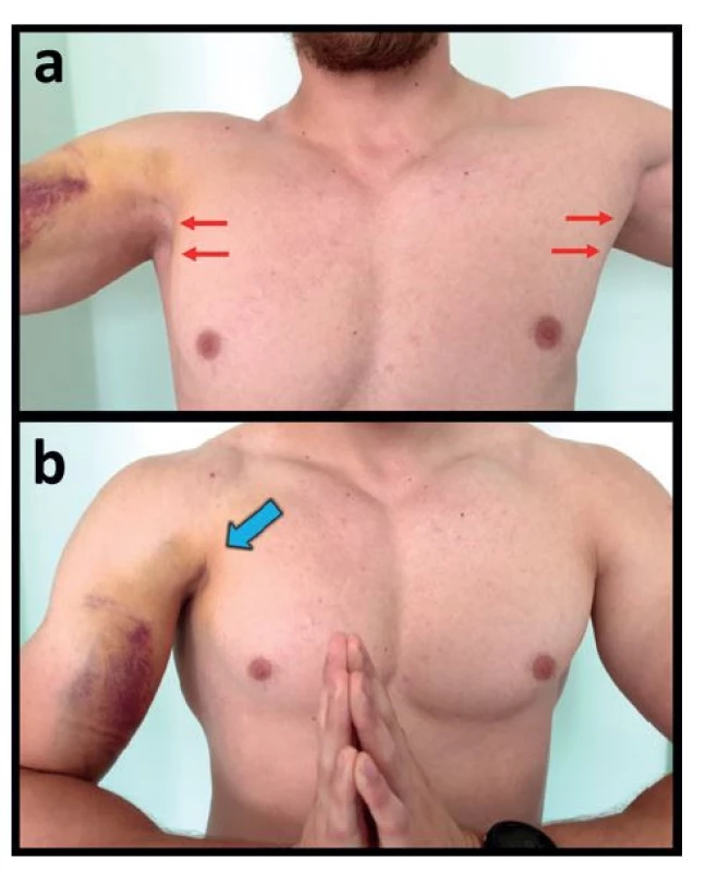 Klinické známky akutní kompletní ruptury obou
porcí m. pectoralis major vpravo v místě inzerce 5 dní po
úrazu<br>
Fig. 3: Clinical signs of acute complete rupture of both
pectoralis major portions on the right side at the insertion
site 5 days after the injury