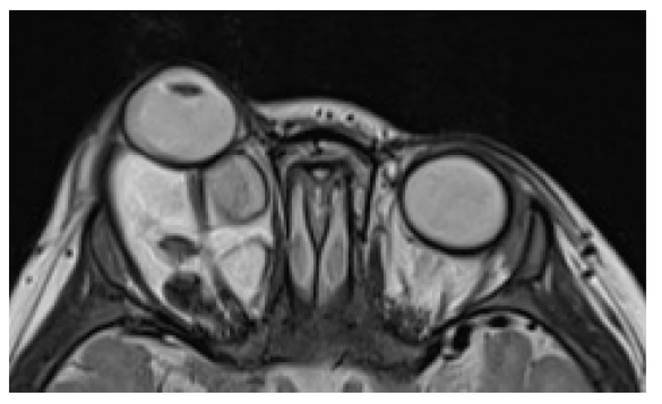 MRI examination at the age of 10 months with
evident proptosis of the right eyeball and stretching of the
optic nerve