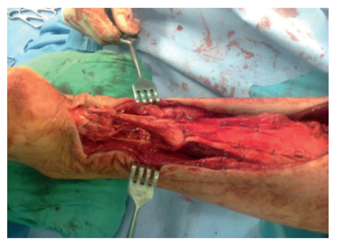 Provedena flap-turn plastika dle Lindholma
s O-augmentací šlachou m. plantaris<br>
Fig. 8: Flap-turn plasty using the Lindholm technique and
O-shaped augmentation with the plantaris muscle were
performed