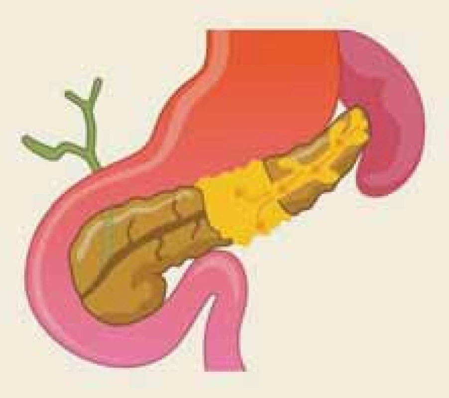 Anatomická situace při syndromu odpojeného pankreatického vývodu – ilustrace.<br>
Fig. 3. The anatomical situation of the
disconnected pancreatic duct syndrome – an illustration.