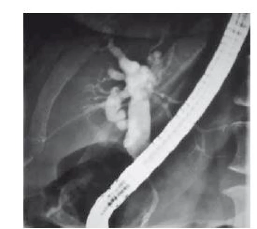 Stenóza distální části ductus choledochus s dilatací extra i intrahepatálních žlučových cest.<br>
Fig. 1. Terminal common bile duct stenosis
with dilatation extra and intrahepatic
bile ducts.