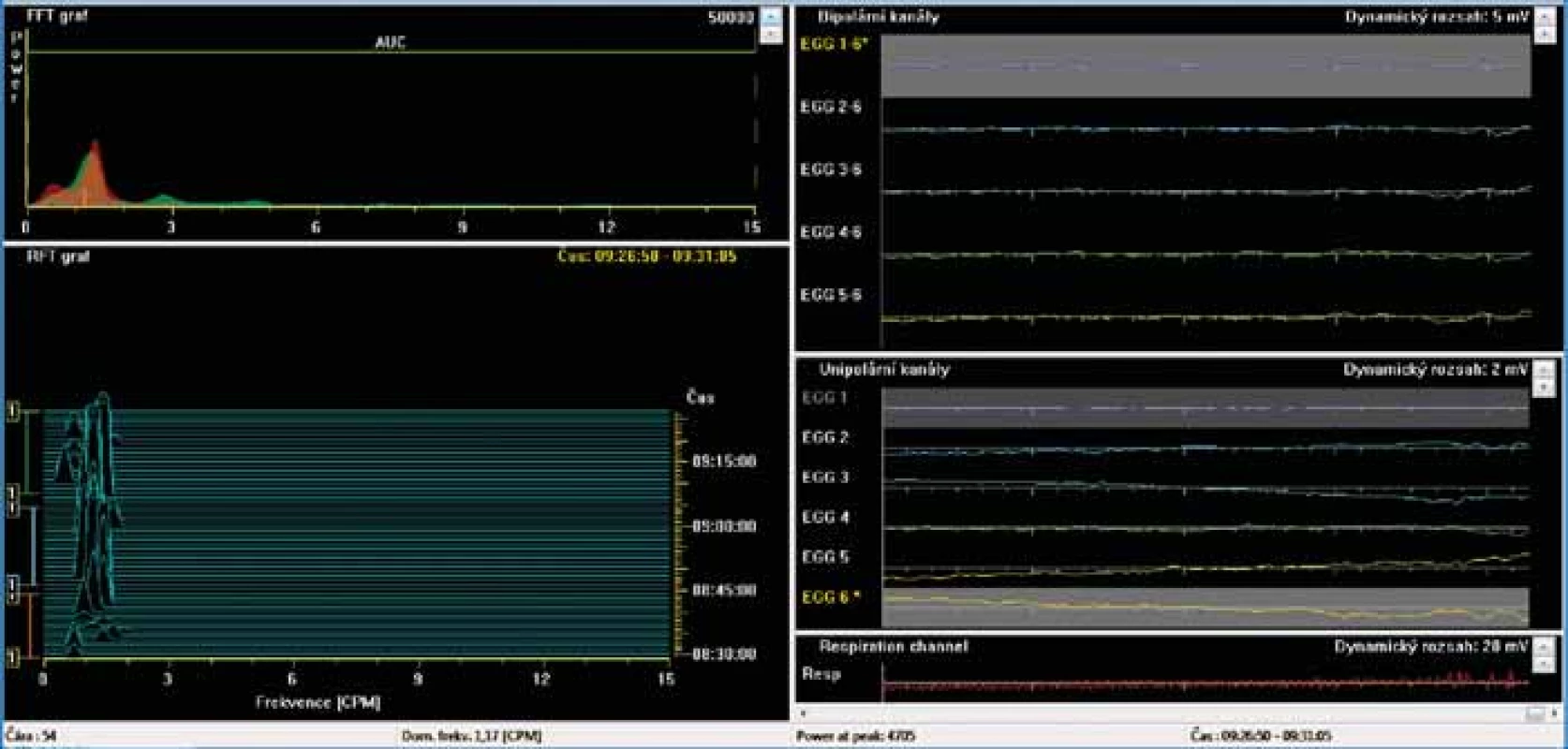 Electrogastrography (EGG). Bradygastria (0.5 to 2 cycles per minute). AUC: areas of amplitudes (EGG power) –
upper left part of the picture; respiration channel at the right bottom (red line) is used to identify artefacts caused by
breathing and body movements.<br>
Elektrogastrografi e. Bradygastrie (0,5–2 cykly/min). AUC: plocha pod křivkou (elektrogastrografi cká síla) – levá horní
část obrázku; záznam elektrody snímající dechové pohyby, tak aby byly při vyšetření odlišeny artefakty způsobené
dýcháním – záznam je na obrázku vpravo dole (červená křivka).