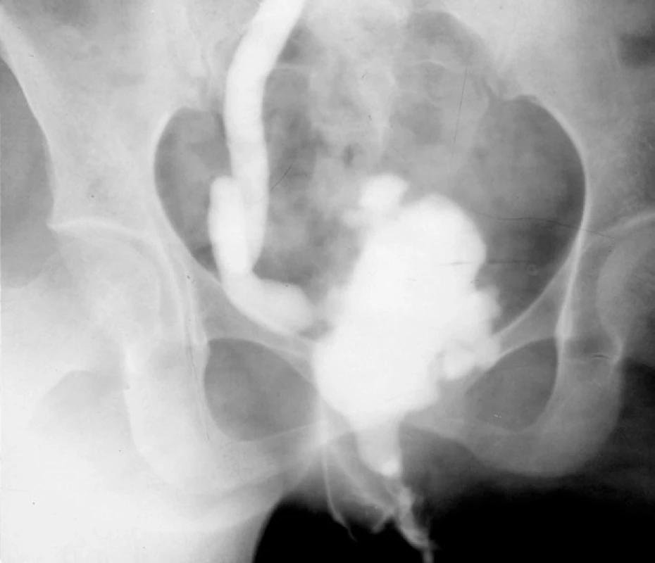 Vylučovací urografie: TB
striktura pravého distálního močovodu
a TB močového měchýře
vysokého stadia s těžkou malformací
tvaru a redukcí jeho kapacity<br>
Fig. 3. Excretory urogram: TB
stricture of the right distal ureter
and bladder in advanced stage
with reduced bladder capacity