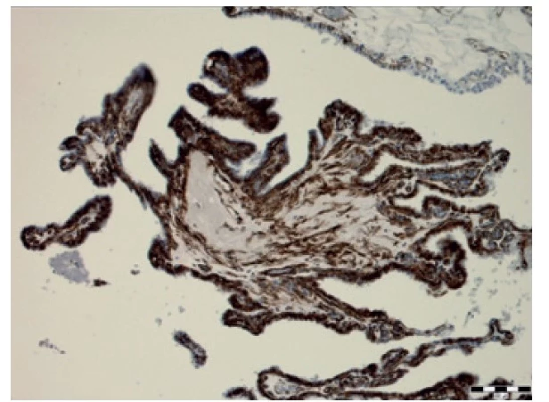 Imunohistochemický průkaz vimentinu (zvětšení 100x).