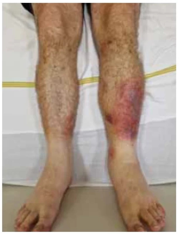 Erytematózní ložiska na
bércích. <br> 
Fig. 1. Erythematous deposits on the
lower legs.