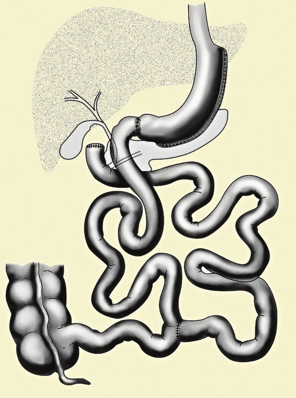 Biliopankreatická diverze typu duodenal switch<br>
Fig. 1: Biliopancreatic diversion, the duodenal switch type
