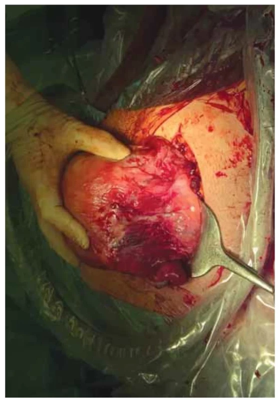 Uterotomie provedena na zadní stěně dělohy.<br>
Fig. 1. Uterotomy made on posterior wall of uterus.