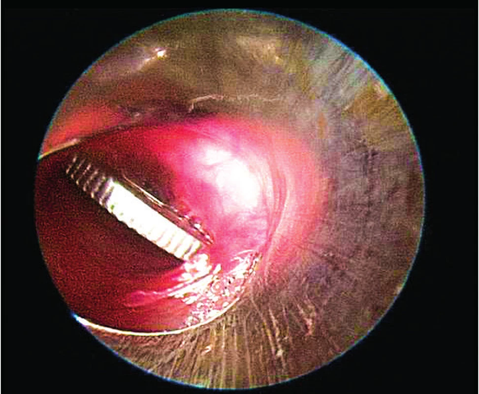 Mince v jícnu. <br><b>Fig. 1. </b>Coin in the esophagus.
