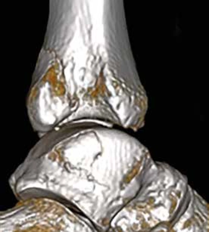 Osteochondrální zlomenina laterální části
kladky talu na 3D CT rekonstrukci po subtrakci
distální fibuly<br>
Fig. 10. 3D CT reconstruction of an osteochondral
fracture of the lateral part of the talar dome after
subtraction of the distal fibula