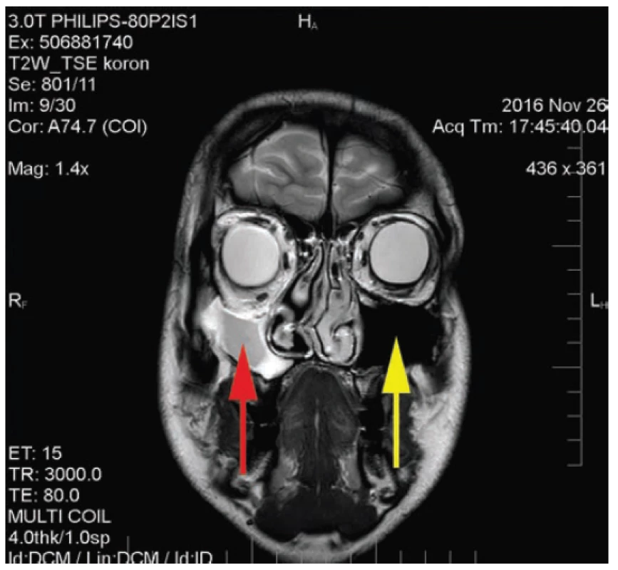 MR scan: reduction of the right maxillary sinus, left maxillary
sinus normal size and ventilation