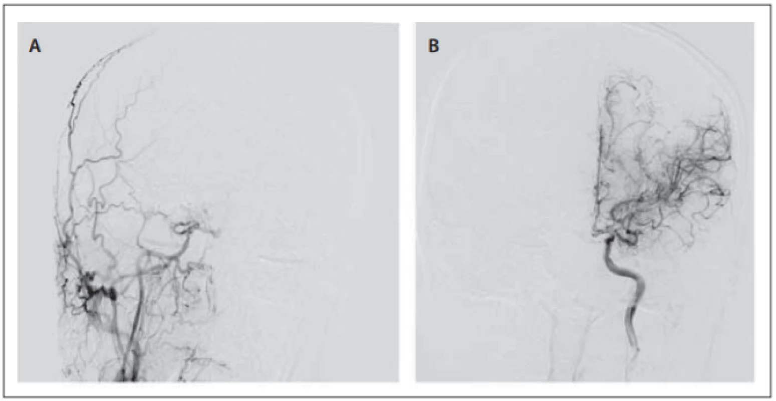 Fig. 1. DSA images of bilateral carotid arteries in anteroposterior view. Occlusion
of the distal segment of the internal carotid arteries with moyamoya vessels at the
skull base (A, B).<br>
Obr. 1. DSA karotid v předozadním zobrazení. Oboustranná okluze distálních segmentů
vnitřních karotid s cévněním typu moyamoya u baze lební (A, B). 
