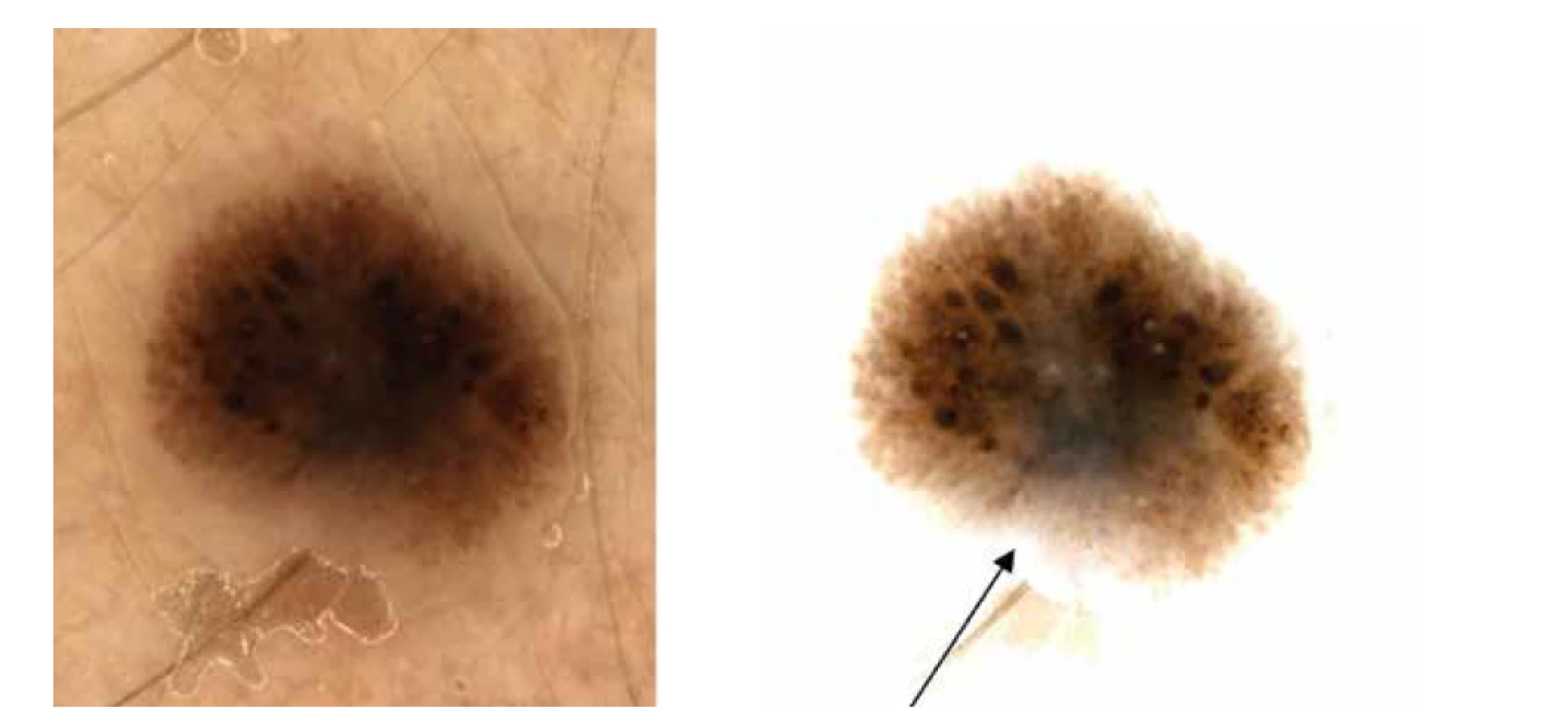 a,b. Dermatoskopicky naznačen obraz připomínající Reedův névus<br>
Na pravém snímku (b) také šedavé zastření v dolní střední části léze (šipka), jinak i naznačená dvouvrstevnatost.