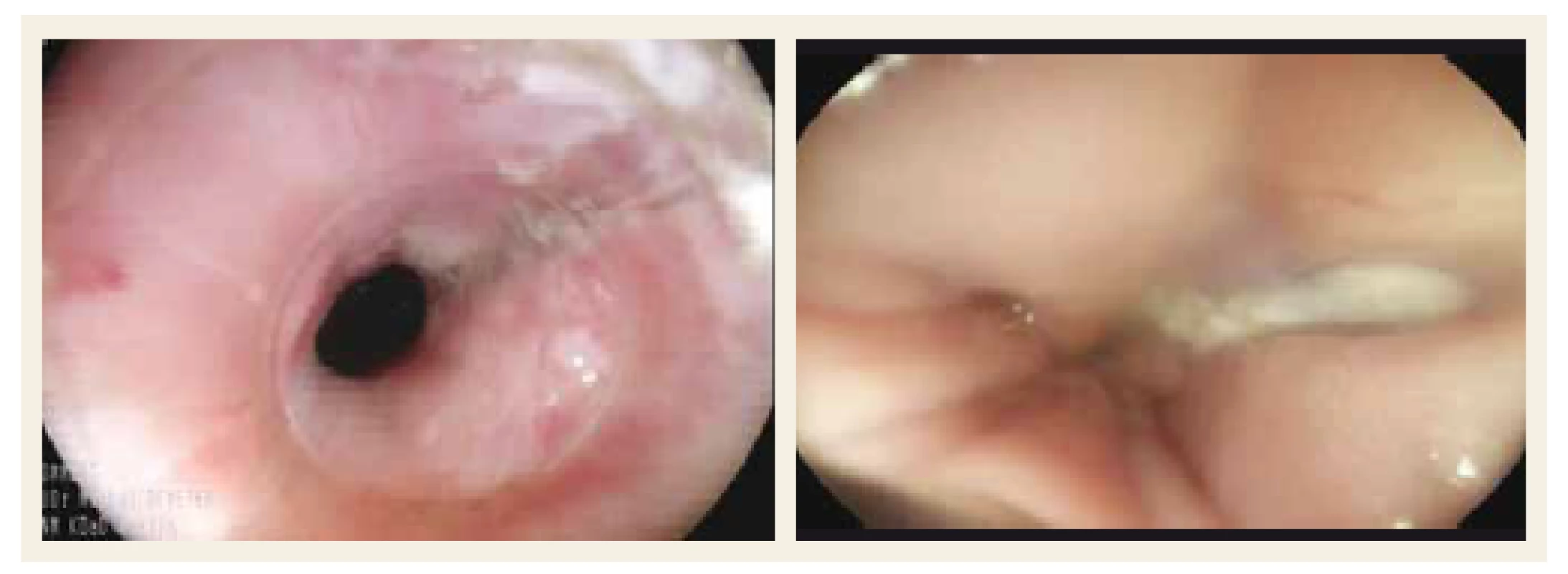Endoskopický obraz termického poškodenia pažeráka.<br>
Fig. 4. Endoscopic picture of thermal oesophageal damage.