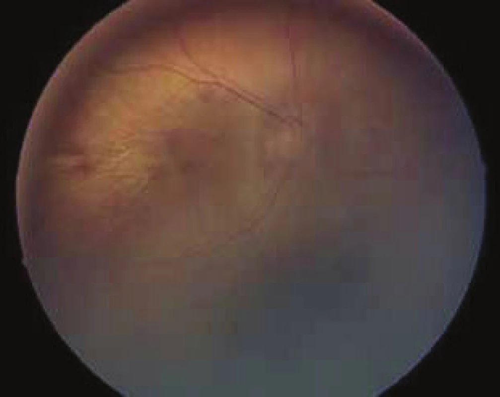 Ocular fundus in patient with Marshall/Stickler syndrome,
left eye. For description see table no. 2.