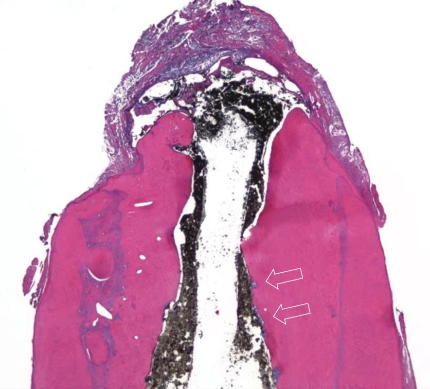 Longitudinal histological section of apical part stained with hematoxylin-eozin; there is abundant deposition of newly produced mineralized tissue with no tubular structure which is demarcated by basophilic layer; arrows point to areas of resorption filled with necrotic tissue (magnification 16×)