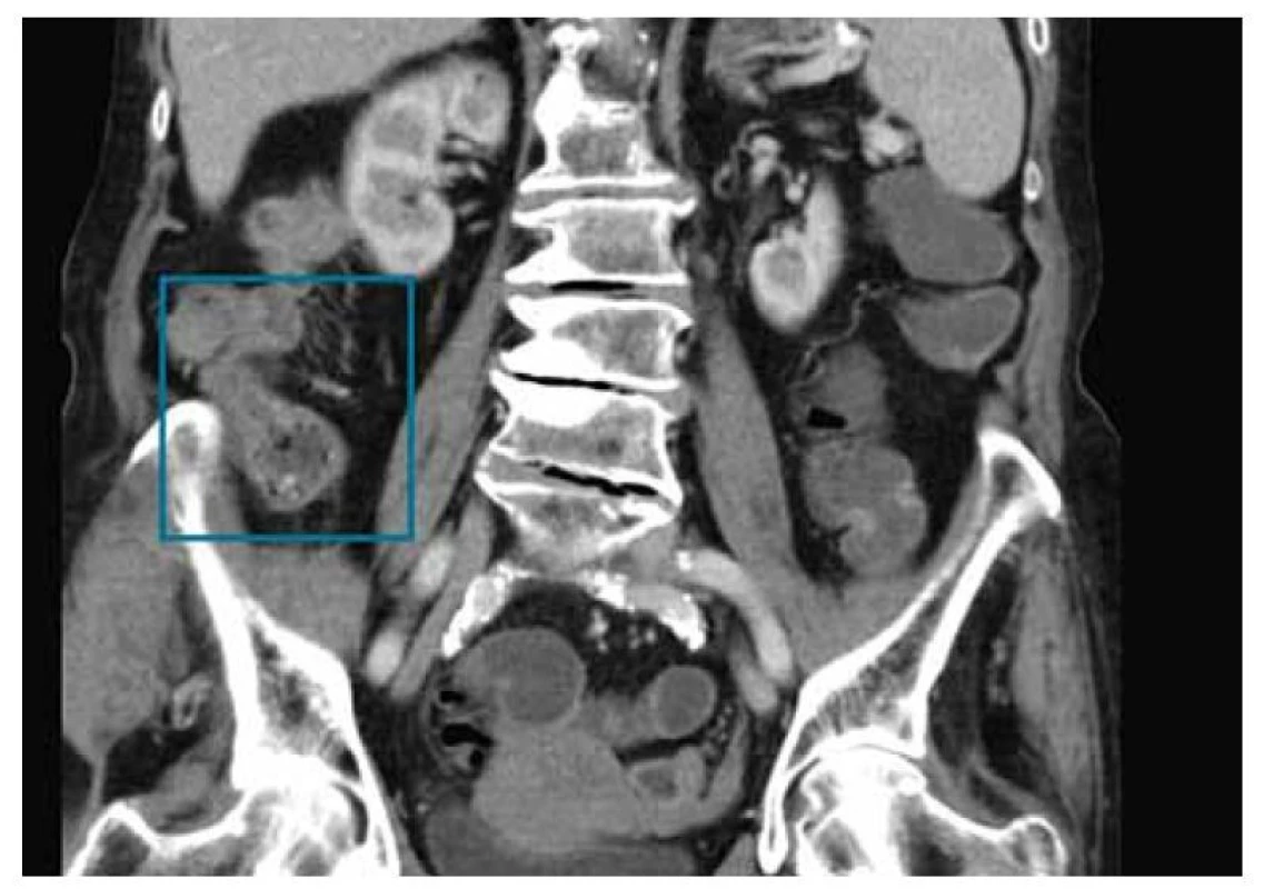 MR enterografie s nálezem skip léze v orální části ilea.<br>
Fig. 3. MR enterography with skip lesion of the oral part of the ileum.