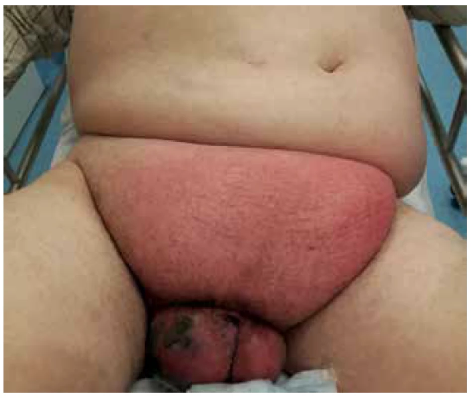 Gangréna skrota s flegmonou v podbřišku<br>
Fig. 1. Scrotal gangrene with hypogastric phlegmon