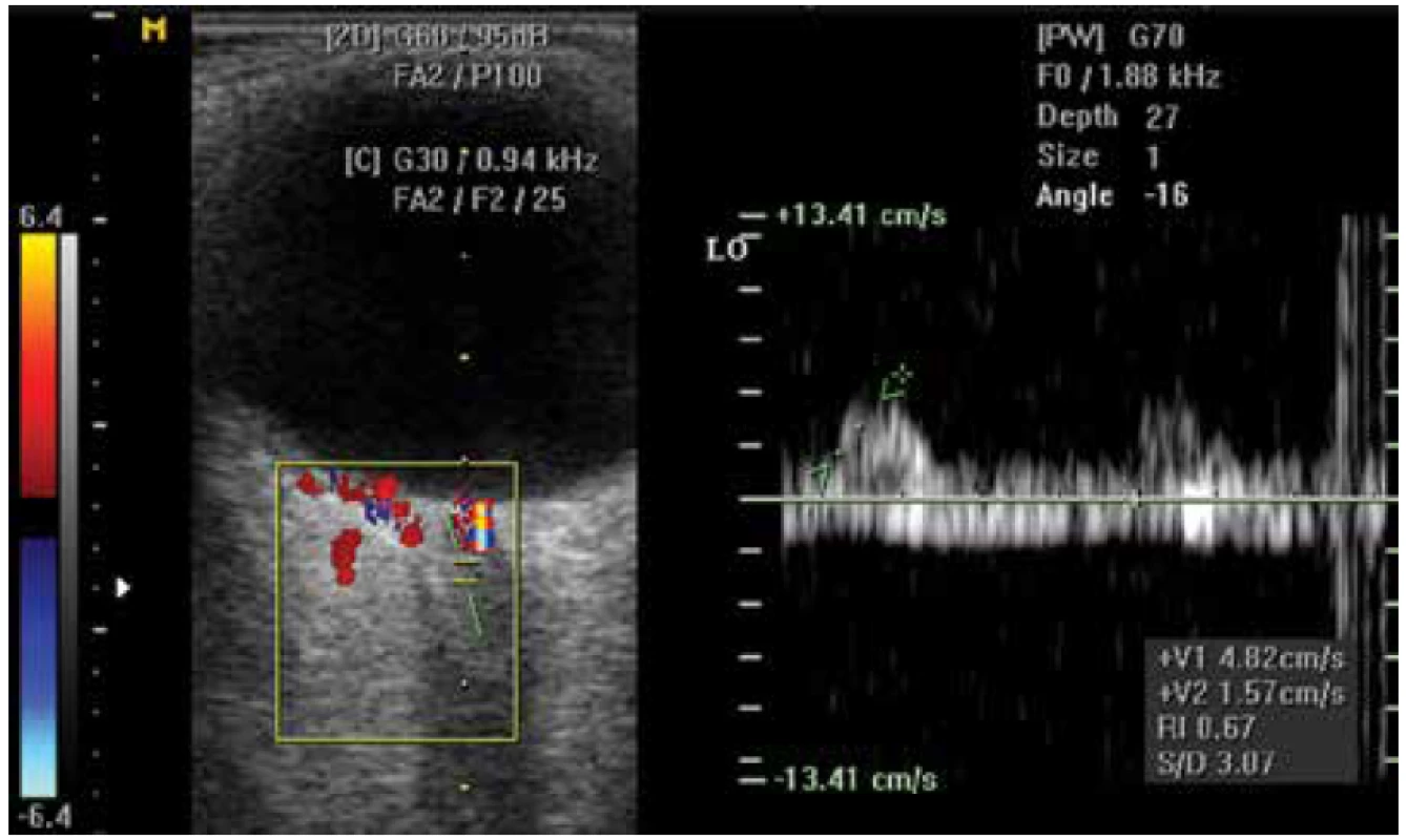 Farebná Doppler ultrasonografia - výrazne nízke prietokové parametre
v arteria centralis retinae