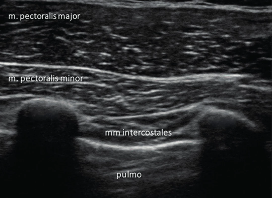 UZ obraz ve 3. mezižebří medioclaviculární čára. Jsou zřejmé tři
vrstvy svalů. Pectoralis major, pectoralis minor, interkostální svaly