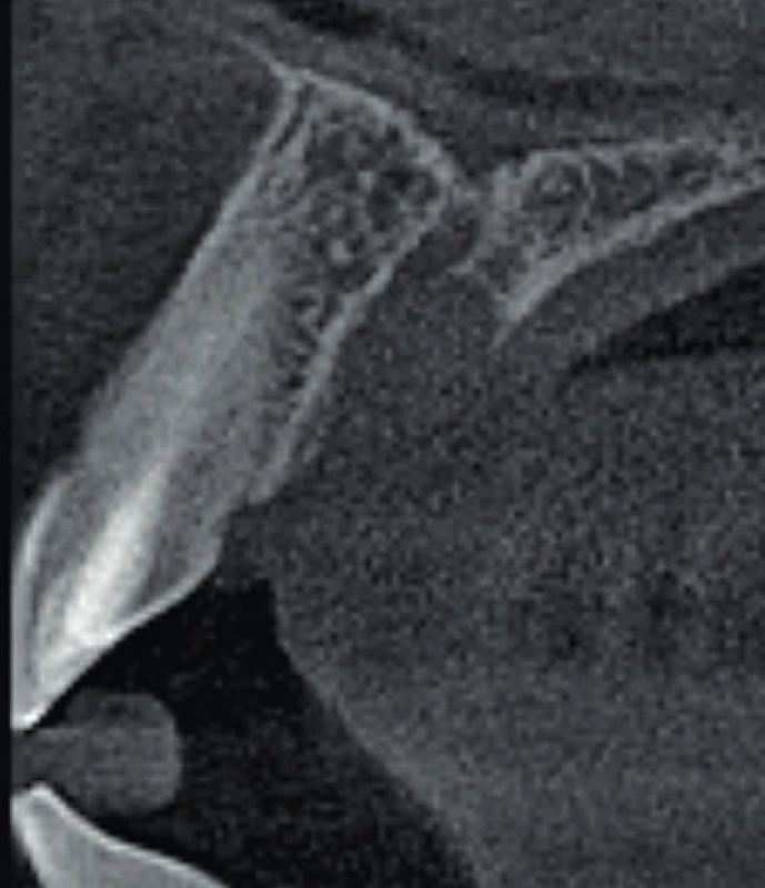 Axiální řez CBCT
snímku meziálně od zubu 11.
Je viditelné rozšíření nazopalatinálního
kanálu, které
nemá spojitost se zubem 11