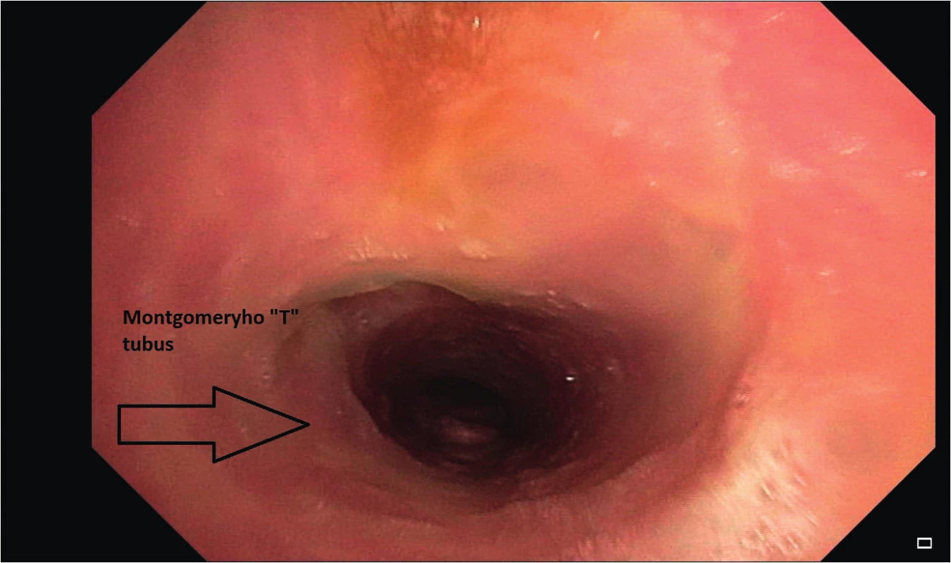 Montgomeryho T tubus <i>in situ</i>