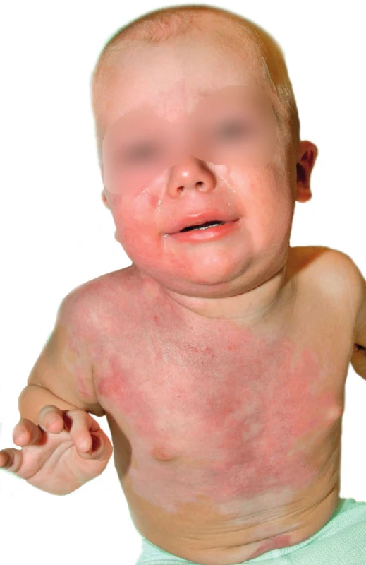Post-burn day 26: Full healing. Patient was discharged
from hospital