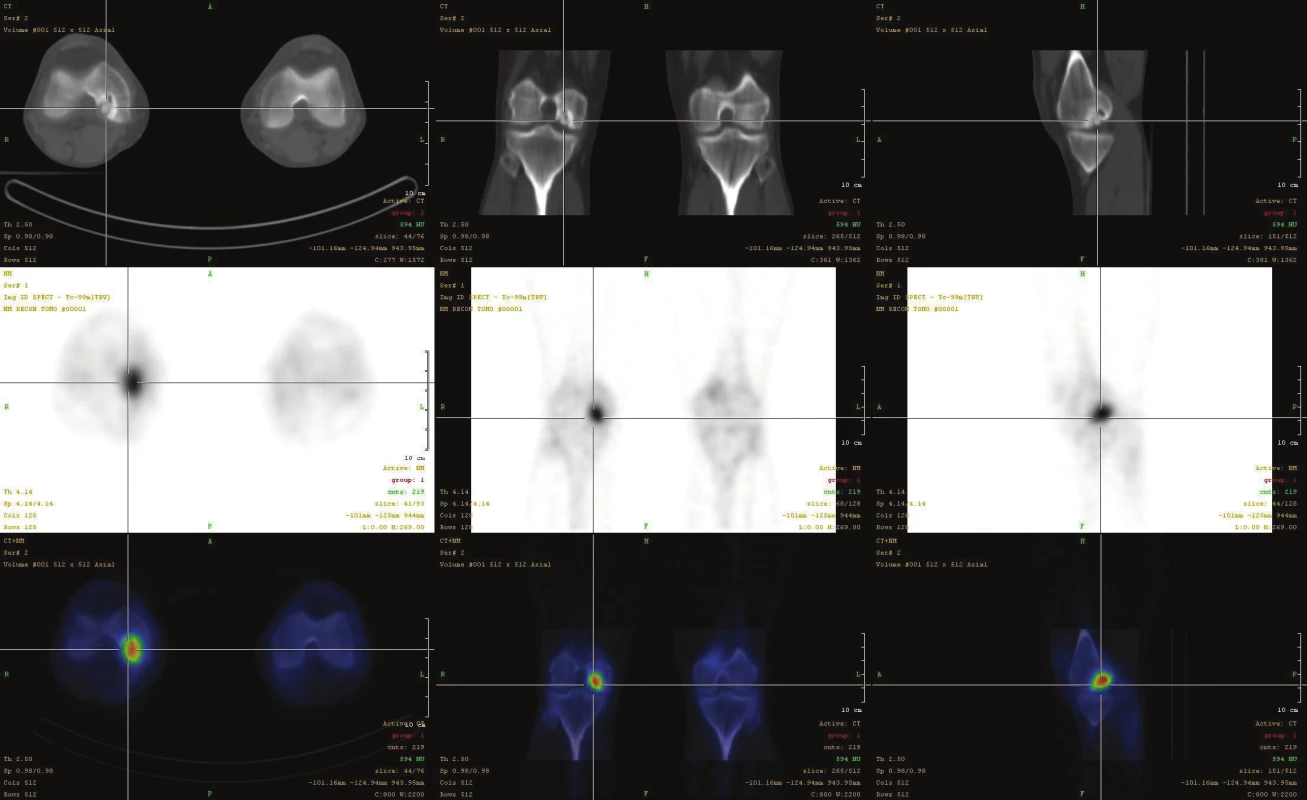 Fúze SPECT/CT obrazu u pacienta s disekující osteochondritidou v „klasické lokalizaci“ – v laterální části mediálního kondylu femuru
ve stádiu III. V horní řadě je obraz z LDCT postupně v transaxiální, koronární a sagitální rovině. Střední řada ukazuje odpovídající SPECT
řezy. Dolní řada prezentuje odpovídající fúzované SPECT/CT řezy. Scintigrafický nález v pozdějších stádiích nemusí být extrémně výrazný,
nález na LDCT je typický.