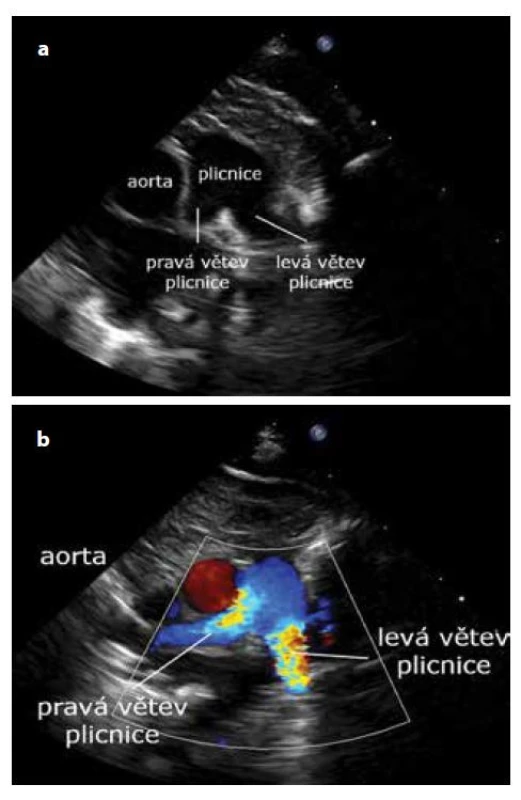 a, b. Suprasternální projekce – větvení plicnice