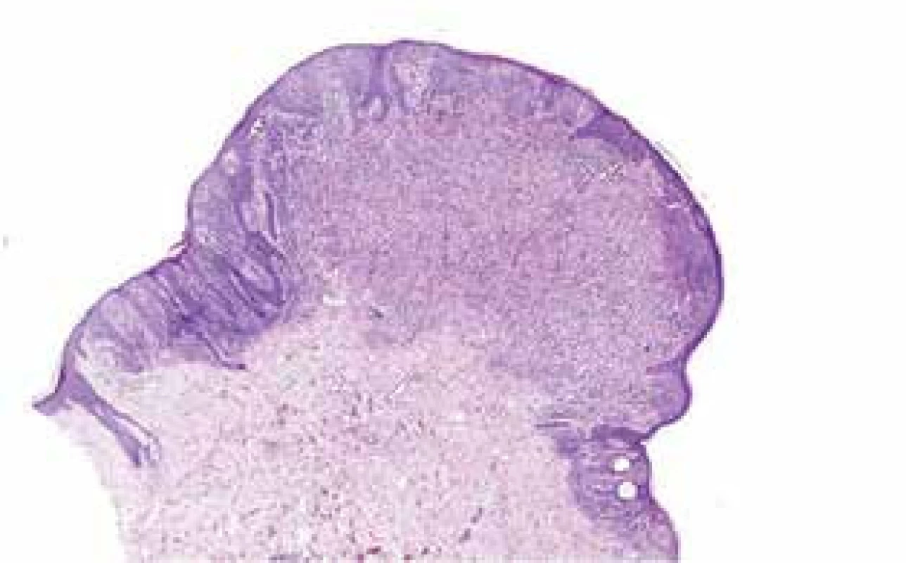 Histologický nález – uprostřed melanom, v okrajích névus
(HE, zvětšení 20x)