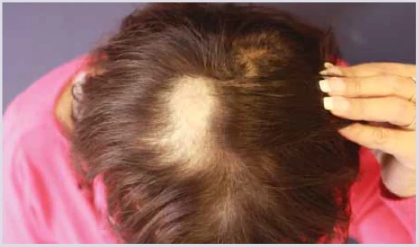 Alopecia areata. <br> 
Fig. 11. Alopecia areata.