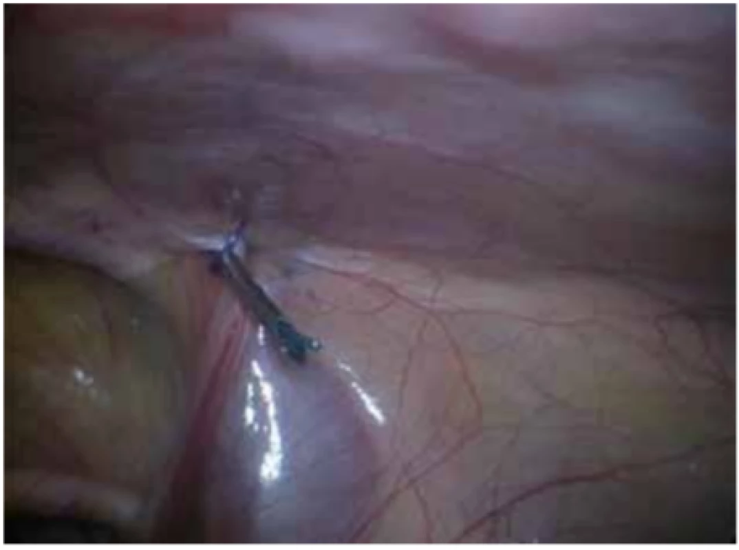Definitivní vlákno zavedené jehlou<br>
Fig. 7: The definite thread introduced using a needle