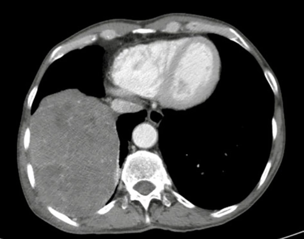 CT hrudníku s obrazem objemného tumoru pravého
hemithoraxu<br>
Fig. 2: CT-scan of the chest showing a voluminous tumor
mass in the right hemithorax