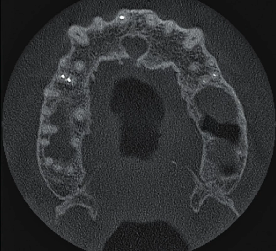 Horizontální řez
CBCT snímku v apikální třetině
délky kořenů horních
středních řezáků. Průběh
rozšířeného nazopalatinálního
kanálu nemá souvztažnost
s kořenem zubu 11