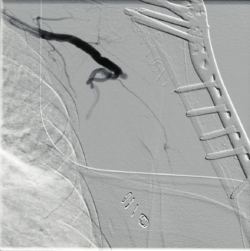 PTA of axillary artery closure with recanalization via common
femoral artery