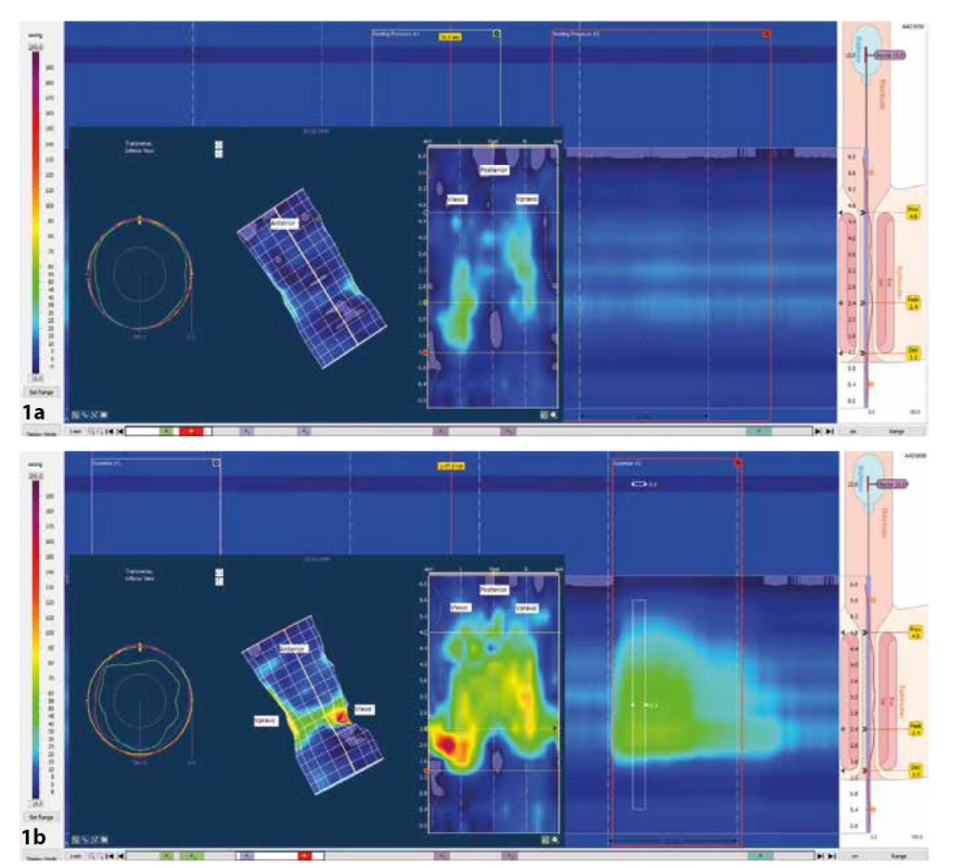 Hypotenzní svěrač s hypokontraktilitou u pacientky s fekální inkontinencí<br>
1a – svěrač v klidu: vlevo 3D model tlakových poměrů análního kanálu v klidové fázi. Uprostřed rozložený 3D model do 2D zobrazení
k usnadnění stranové orientace. Vpravo 2D záznam. Výrazně snížený tlak v análním kanálu s jen naznačeným tonem v oblasti
externího svěrače vpravo a vlevo.<br>
1b – svěrač v maximálním sevření: vlevo 3D model tlakových poměrů análního kanálu ve fázi sevření. Uprostřed rozložený 3D
model do 2D zobrazení k usnadnění stranové orientace. Vpravo 2D záznam. 3D model prokazuje nedostatečné utažení smyčky m.
puborectalis (proximálně v zadní části) a sníženou svalovou sílu externího svěrače v přední části (distálně v přední a laterální části).<br>
(Zdroj: archiv Oddělení gastrointestinální endoskopie, Ústřední vojenská nemocnice – Vojenská fakultní nemocnice, Praha)<br>
Fig.1: Hypotensive sphincter with hypocontractility in a patient with a fecal incontinence<br>
1a – sphincter at rest: 3D model of pressure conditions of the anal canal in the rest on the left. Unfolded 3D model into 2D view for
better lateral orientation in the middle. 2D record on the right. Significantly reduced pressure in the anal canal with the only small
pressure in the area of the external sphincter on the right and the left.<br>
1b – sphincter in maximum squeeze: 3D model of pressure conditions of the anal canal in the squeeze on the left. Unfolded
3D model into 2D view for better lateral orientation. 2D record on the right. The 3D model shows insufficient tightening of the
puborectalis loop (proximally in the posterior part) and reduced muscular strength of the external sphincter in the anterior part
(distally in the anterior and lateral parts).<br>
(Source: Department of Gastrointestinal Endoscopy archive, Military University Hospital, Prague)