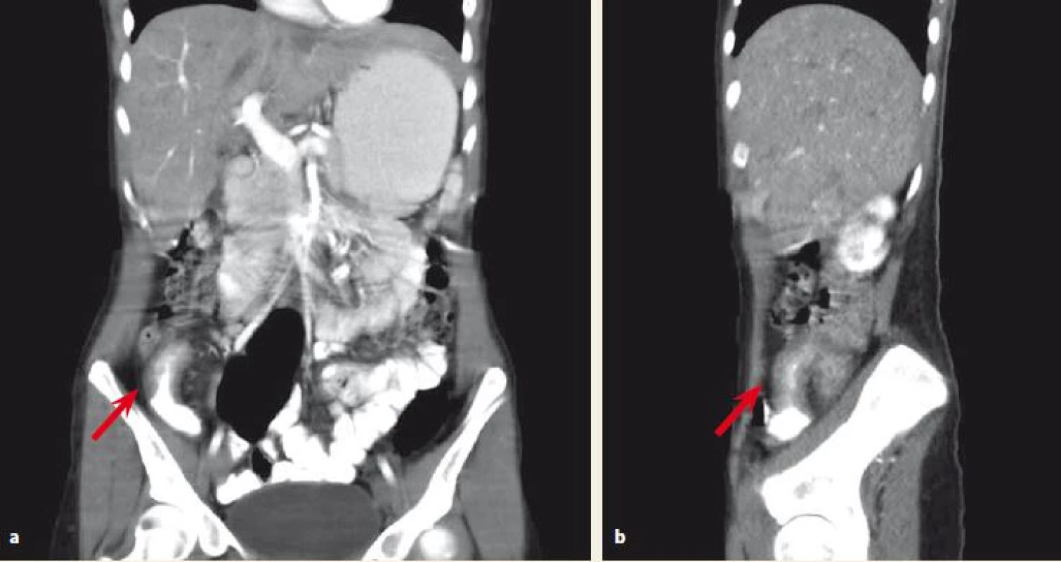 a,b. Abdominal CT scan. Affected terminal ileum marked with an arrow.<br>
Obr. 1a,b. CT vyšetření břicha. Postižení terminálního ilea označeno šipkou.
