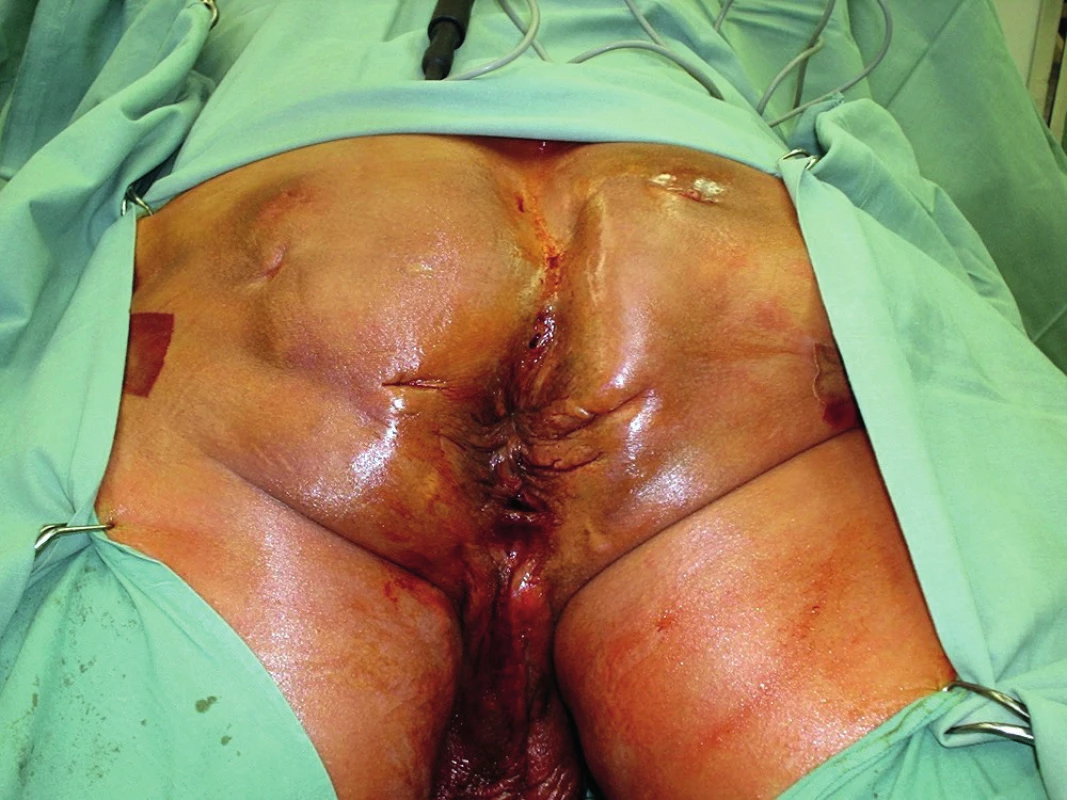 Předoperační nález<br>
Fig. 2: Preoperative finding