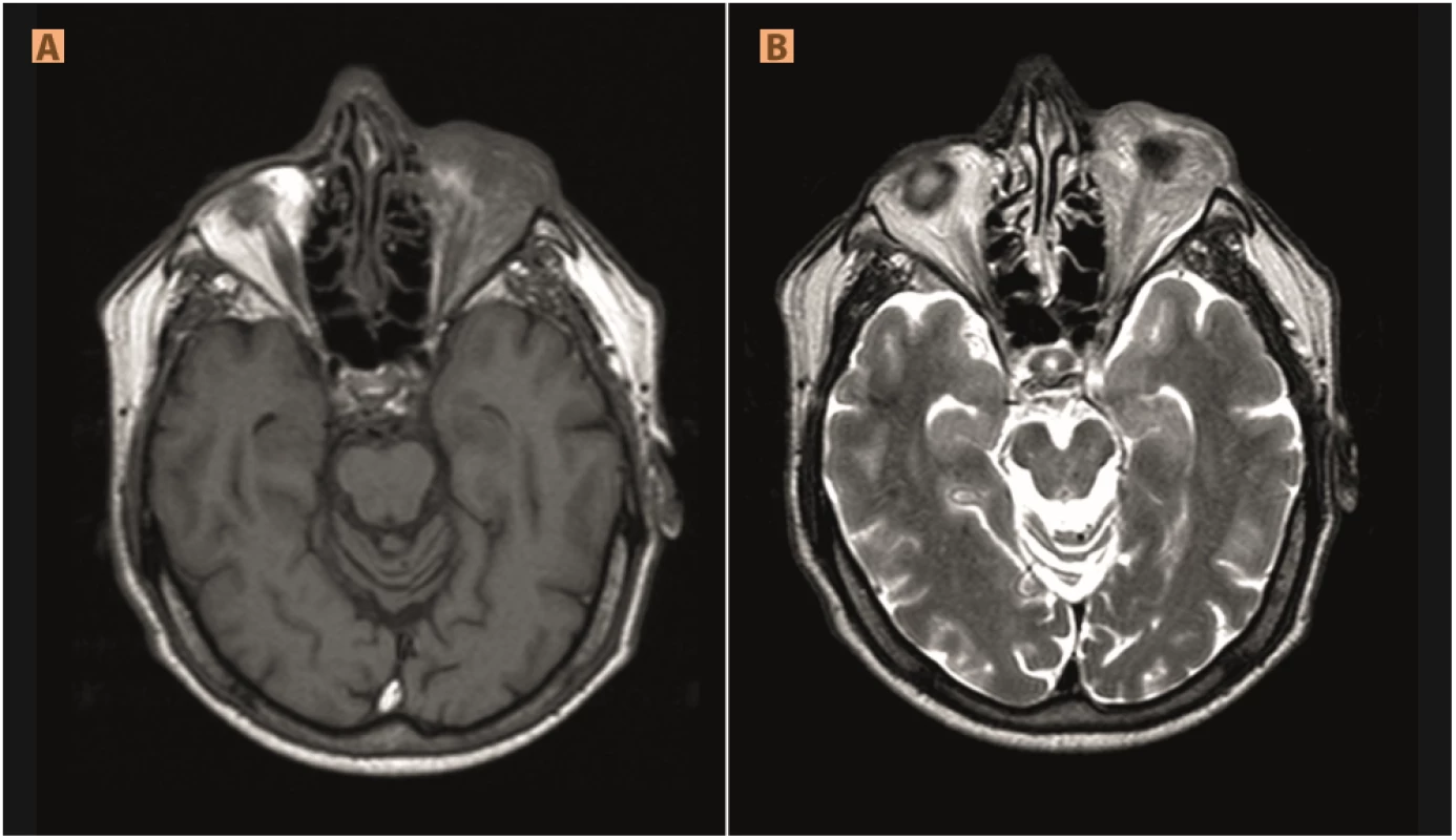 Pseudotumour (A) non-homogeneous hyposignal infiltration of left orbit in T1WI and (B) non-homogeneous hypersignal in T2WI, protrusion of left eyeball
