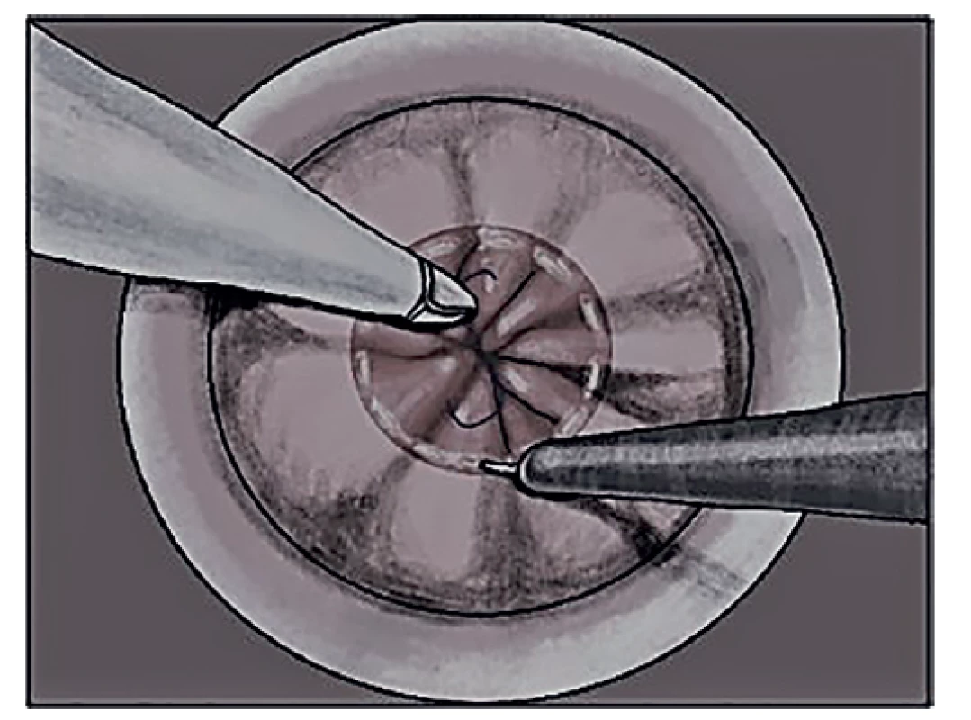 Transekce rekta aborálně od tabákového stehu<br>
Fig. 4: Rectal transection below the circular suture