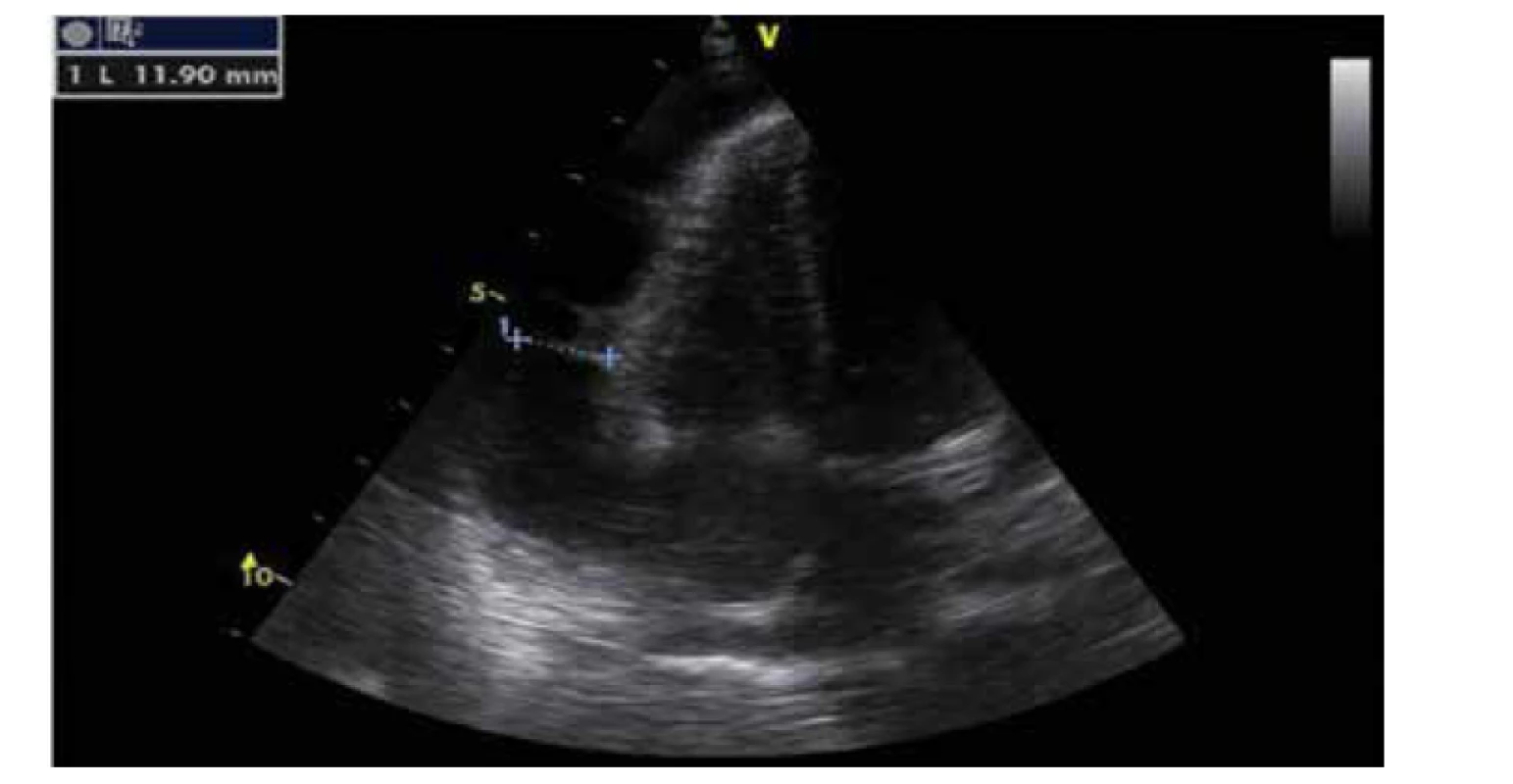 Významný perikardiální výpotek (apikální čtyřdutinová projekce).<br>
Fig. 2. Significant pericardial effusion (apical projection).