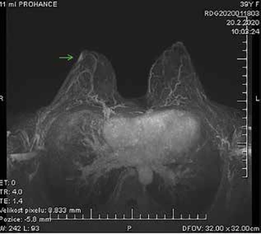 MRI prsů − vpravo deformace a infiltrace mamily<br>
Fig. 3: MRI of the breast − deformity and infiltration of the
nipple on the right