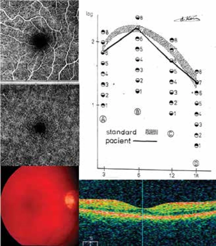 DpR2: CS, SD-OCT, OCT-A a fundus u pacientky 20
(Tabulka 1)