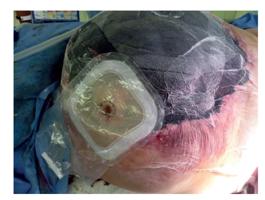 Píštěl s jímacím sáčkem<br>
Fig. 3: Fistula with a collection bag