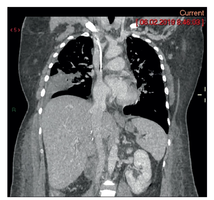 Pooperačný stav – po nefrektómii a vena cava inf.
bez nádorového trombu<br>
Fig. 4: Postoperative condition – after nephrectomy, with
the tumor thrombus removed from the inferior vena cava