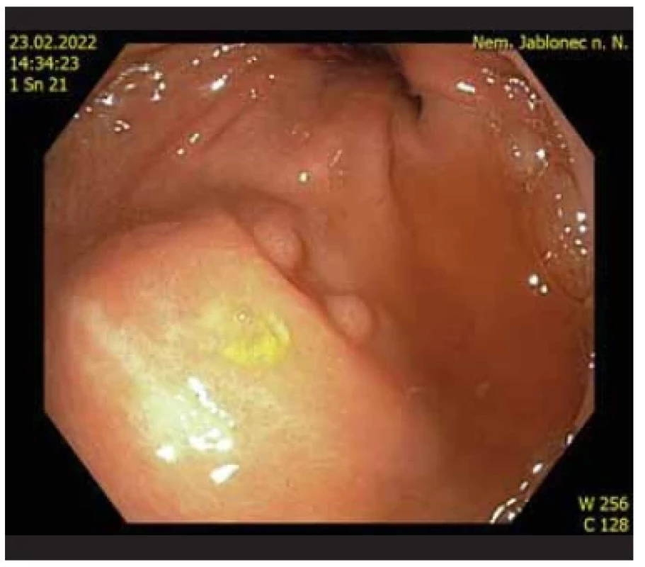 Pohřbený LAMS pod sliznicí žaludku. <br> 
Fig. 7. Buried LAMS under the gastric mucosa.