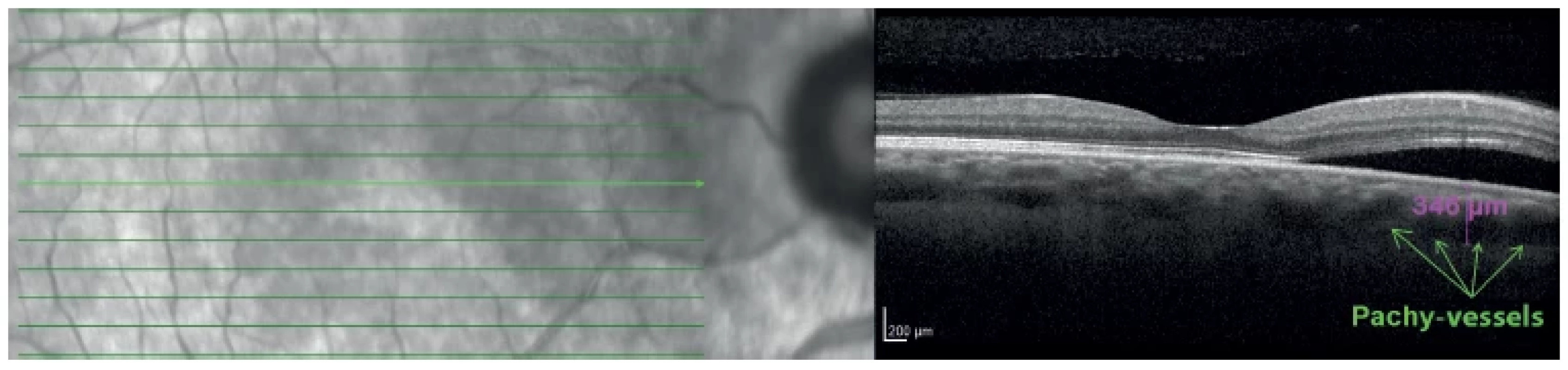 Linear horizontal transfoveolar OCT scan of right eye: peripapillary pachychoroid syndrome, neuroretinal ablation in
peripapillary zone